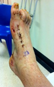 Dylan's foot after surgery